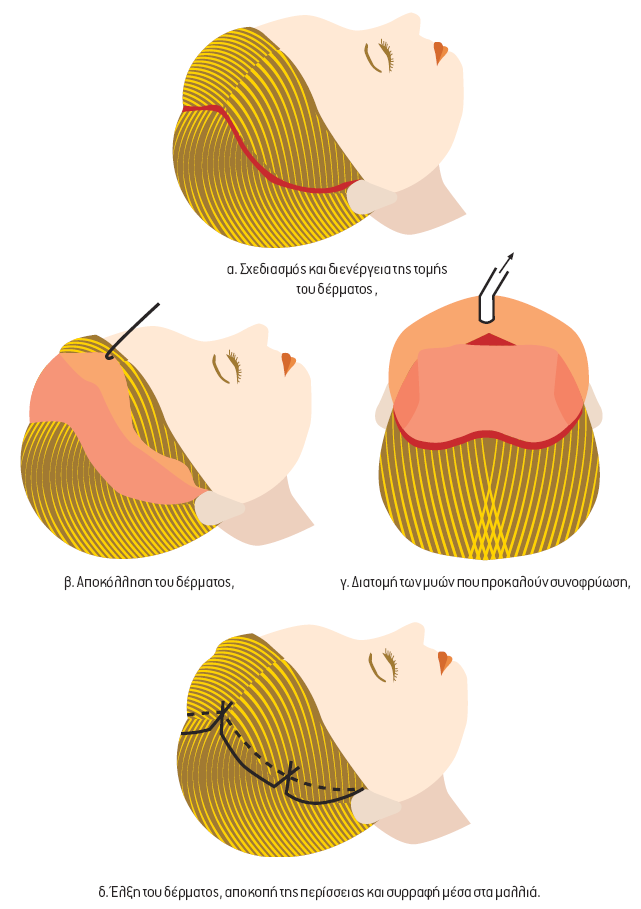 Εηθόλα 5: Αλνηθηή ξπηηδνπιαζηηθή ηνπ πξνζώπνπ: α ρεδηαζκόο θαη δηελέξγεηα ηεο ηνκήο ηνπ δέξκαηνο, β Απνθόιιεζε ηνπ δέξκαηνο, γ Δηαηνκή ησλ κπώλ πνπ πξνθαινύλ ζπλνθξύσζε, δ Έιμε ηνπ δέξκαηνο, απνθνπή