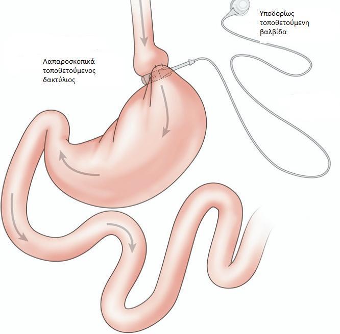 ΓΑΣΡΙΚΟ ΔΑΚΣΤΛΙΟ (LAPAROSCOPIC