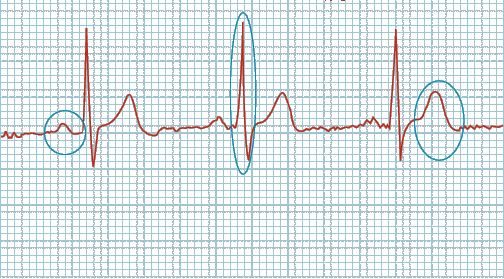 Ηλεκτροκαρδιογράφημα (ECG) Μέρη του ΗΚΓ διέγερση του φλεβόκομβου και των κόλπων κύμα Ρ δεμάτιο His και διέγερσης στις κοιλίες σύμπλεγμα QRS αναπόλωση στις κοιλίες κύμα Τ