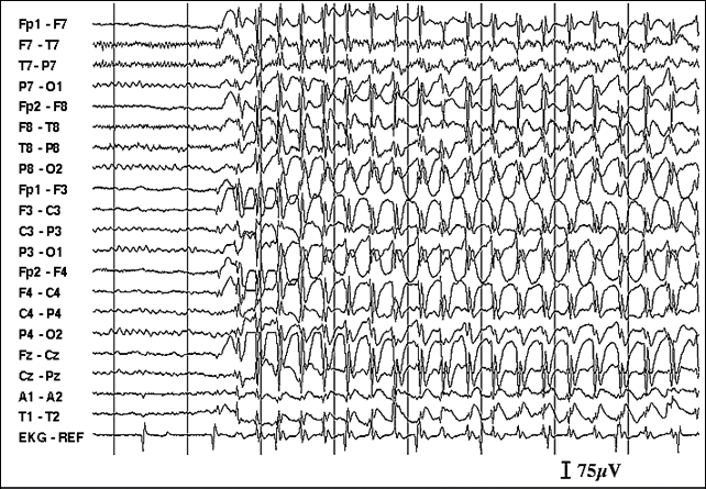Ηλεκτροεγκεφαλογράφημα (EEG) Επιληψία Επαναλαμβανόμενες κρίσεις Αιτίες: Όγκος, τραύμα, μόλυνση, αγγειακή νόσος, αλλά σε πολλές περιπτώσεις άγνωστη αιτία Τύποι:
