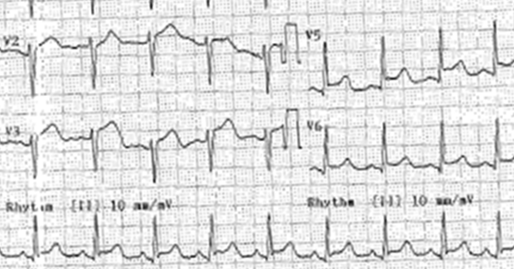 1. STEMI? 2. Μυοκαρδίτιδα? 3. Περικαρδίτιδα?