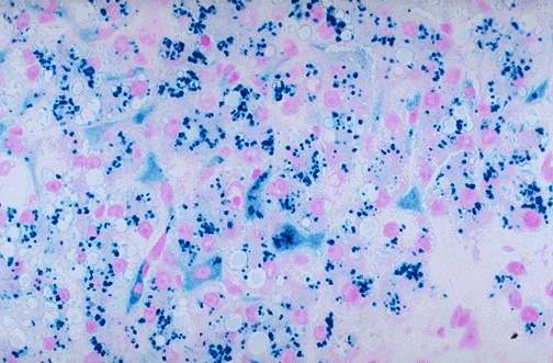 iron stain : αναδεικνύει κοκκία αιμοσιδηρίνης (μπλε