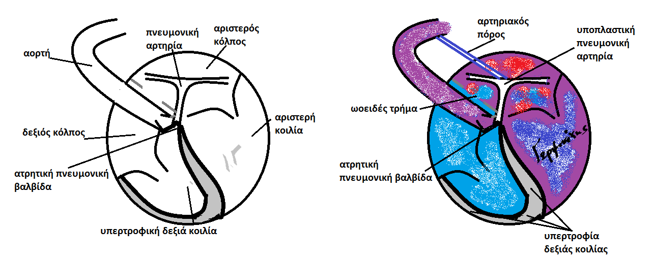 Εικόνα 6.2. Ατρησία πνευµονικής αρτηρίας µε ακέραιο µεσοκοιλιακό διάφραγµα. Η ατρητική πνευµονική βαλβίδα οδηγεί σε υπερτροφία της δεξιάς κοιλίας και σε υποπλασία της πνευµονικής αρτηρίας (αριστερά).