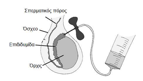 επιδιδυμίδα.