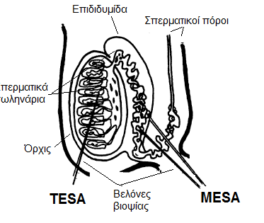 Θ λιψθ ςπερματοηωαρίων με τισ τεχνικζσ TESA και MESA Διαδερμικι αναρρόφθςθ ςπζρματοσ από τθν επιδιδυμίδα (Percutaneous
