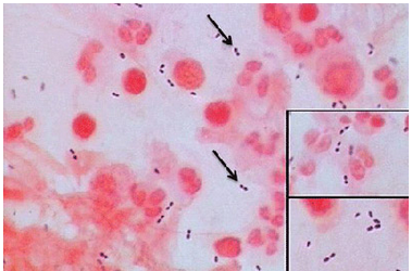 Μικροσκοπική εξέταση Η χρώση Gram είναι θετική στο 60-80% των περιπτώσεων βακτηριακή µηνιγγίτιδα Η ευαισθησία ποικίλλει ανάλογα το µικροοργανισµό και