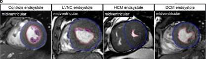 Υπερδοκίδωση- Διαφορική Διάγνωση- cmr NC/C ratio: - LVNC: συνήθως > 3 - Λοιπές ομάδες: συνήθως < 2 Trabeculated LV mass%: - LVNC: > 20% (3x) - Λοιπές ομάδες: