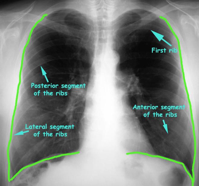 X-Ray 2nd