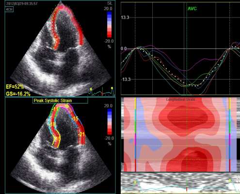 LV LONGITUDINAL