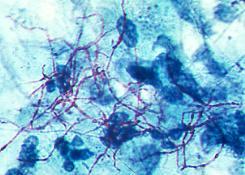 Οξεάντοχα Mycobacterium spp Mycobacterium leprae Nocardia spp Gordonia spp Tsukamurella spp