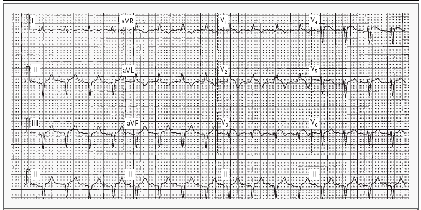 νέο RBBB (QR) + ανάσπαση του