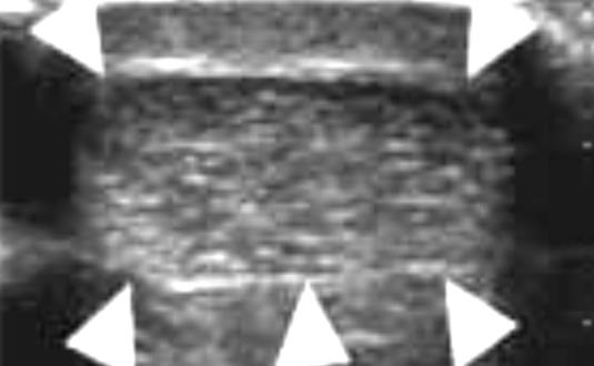 ΦΥΣΙΟΛΟΓΙΚΗ US ΑΝΑΤΟΜΙΑ Επιμήκης τομή: Η έκφυσή του απεικονίζεται στο σημείο όπου παχύνεται η περιτονία του γαστροκνημίου και λεπτύνεται το κάτω άκρο του υποκνημίδιου μυός.