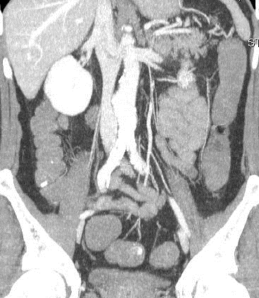 CT ευρήματα-gi bleeding Οι ασθενείς που λαμβάνουν αντιπηκτική αγωγή εμφανίζουν υψηλό κίνδυνο αιμορραγίας από τον πεπτικό σωλήνα.