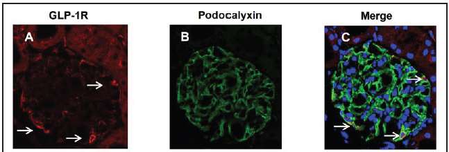 Αναστολή DPP-4 και Νεφροπροστασία Upregulation of DPP-4 expression in renal glomeruli during inflammation