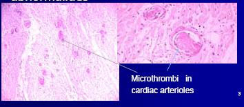 ΘΘΠ-Ιστολογικά ευρήματα H&E VWF Fibrin Brain