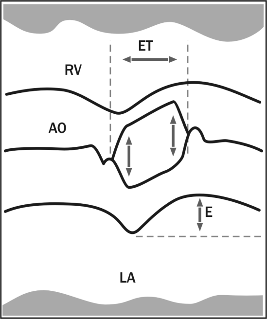 51 5. Το μέγεθος του αριστερού κόλπου. Σχήμα 3.2. Μέθοδοι προσδιορισμού όγκου παλμού: 1. Αρχική διάνοιξη αορτής, 2. τελική διάνοιξη αορτής, ΕΤ. Περίοδος εξώθησης αριστερής κοιλίας, Ε.