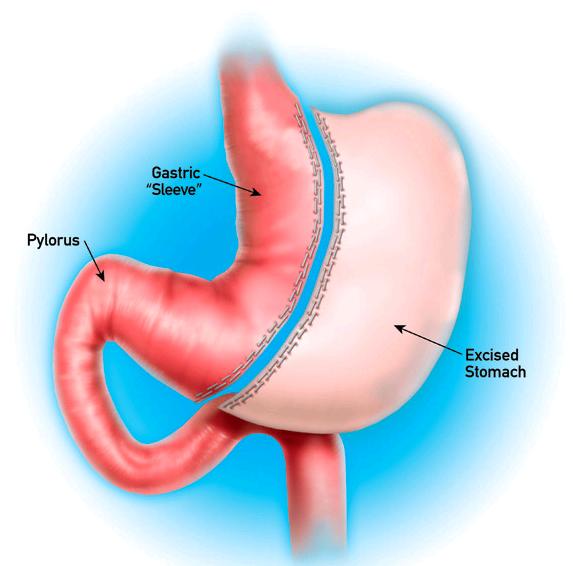 ΕΠΙΜΗΚΗΣ ΓΑΣΤΡΕΚΤΟΜΗ (SLEEVE GASTRECTOMY) Επιμήκης τομή παράλληλα προς το μείζον τόξο του στομάχου Αφαίρεση θόλου, πυθμένα, μεγάλου μέρους του στομάχου Απομένει στενός γαστρικός σωλήνας («γαστρικό