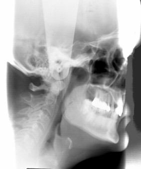 Inadequate respiratory drive Μεραληθέο ηδηόηεηεο αλαπλεπζηηθνύ