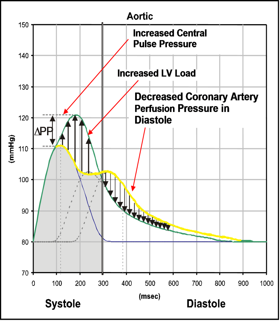 The Impact of the Early Wave Reflection Η πξώτκε άθημε ηνπ αλαθιώκελνπ ζθπγκηθνύ θύκαηνο πξνθαιεί αιιαγή ηεο θπκαηνκνξθήο ηεο πίεζεο ζηελ ανξηηθή ξίδα κε 3 ζεκαληηθέο θιηληθέο επηπηώζεηο : Η πίεζε