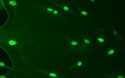 CIS/Actin 0,7 0,6 0,5 0,4 0,3 0,2 0,1 0 C0 C30 P0 P30 Εικόνα: Μπάντες και αποτελέσματα των densitometries της RT-PCR για τη CIS στους μάρτυρες και στους ασθενείς.