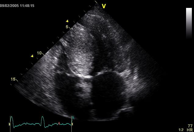 SR imaging is able to discriminate HCM