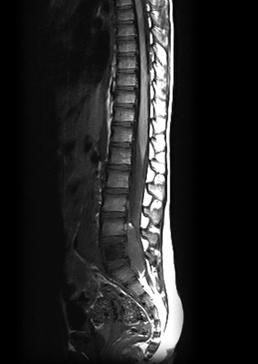 Ewing s σάρκωμα Κακοήθης στρογγυλοκυτταρικός όγκος 10-20 ετών Α/α, CT, MRI: