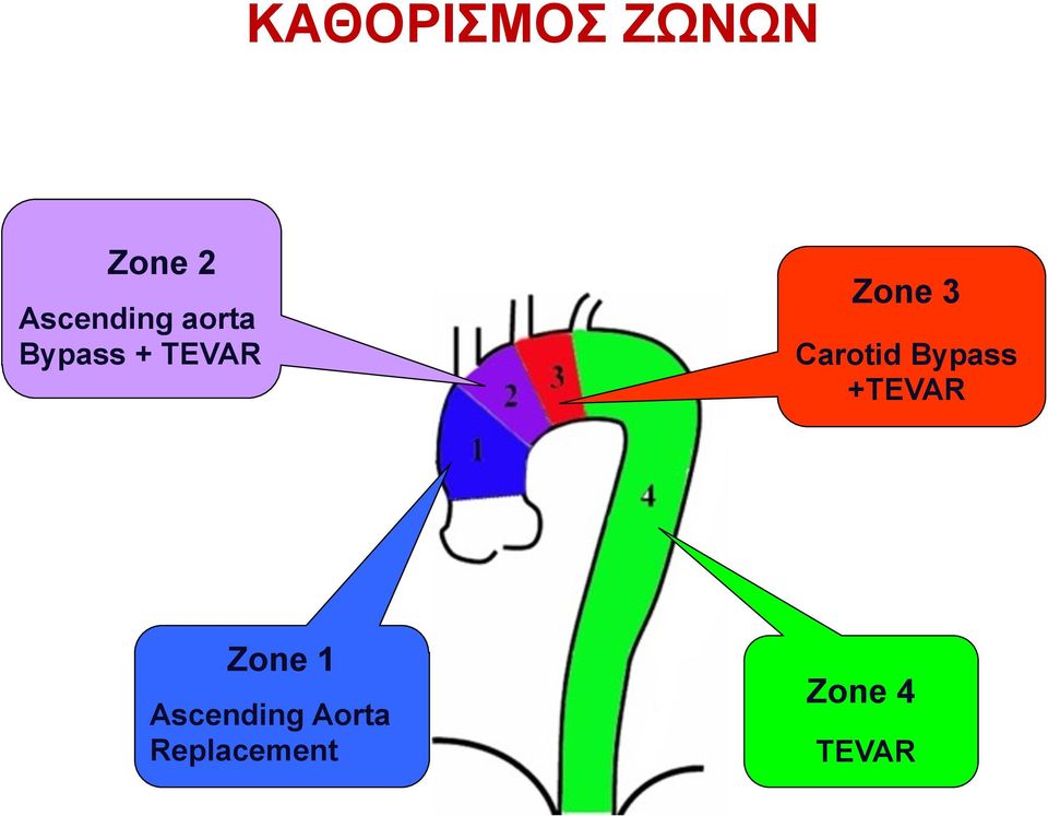 Zone 3 Carotid Bypass +TEVAR