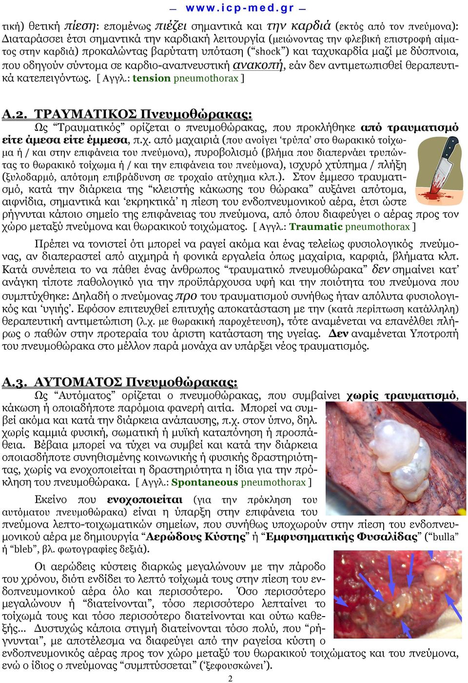 : tension pneumothorax ] Α.2. ΤΡΑΥΜΑΤΙΚΟΣ Πνευµοθώρακας: ΩΩς Τραυµατικός ορίζεται ο πνευµοθώρακας, που προκλήθηκε από τραυµατισµό είτε άµεσα είτε έµµεσα, π.χ.