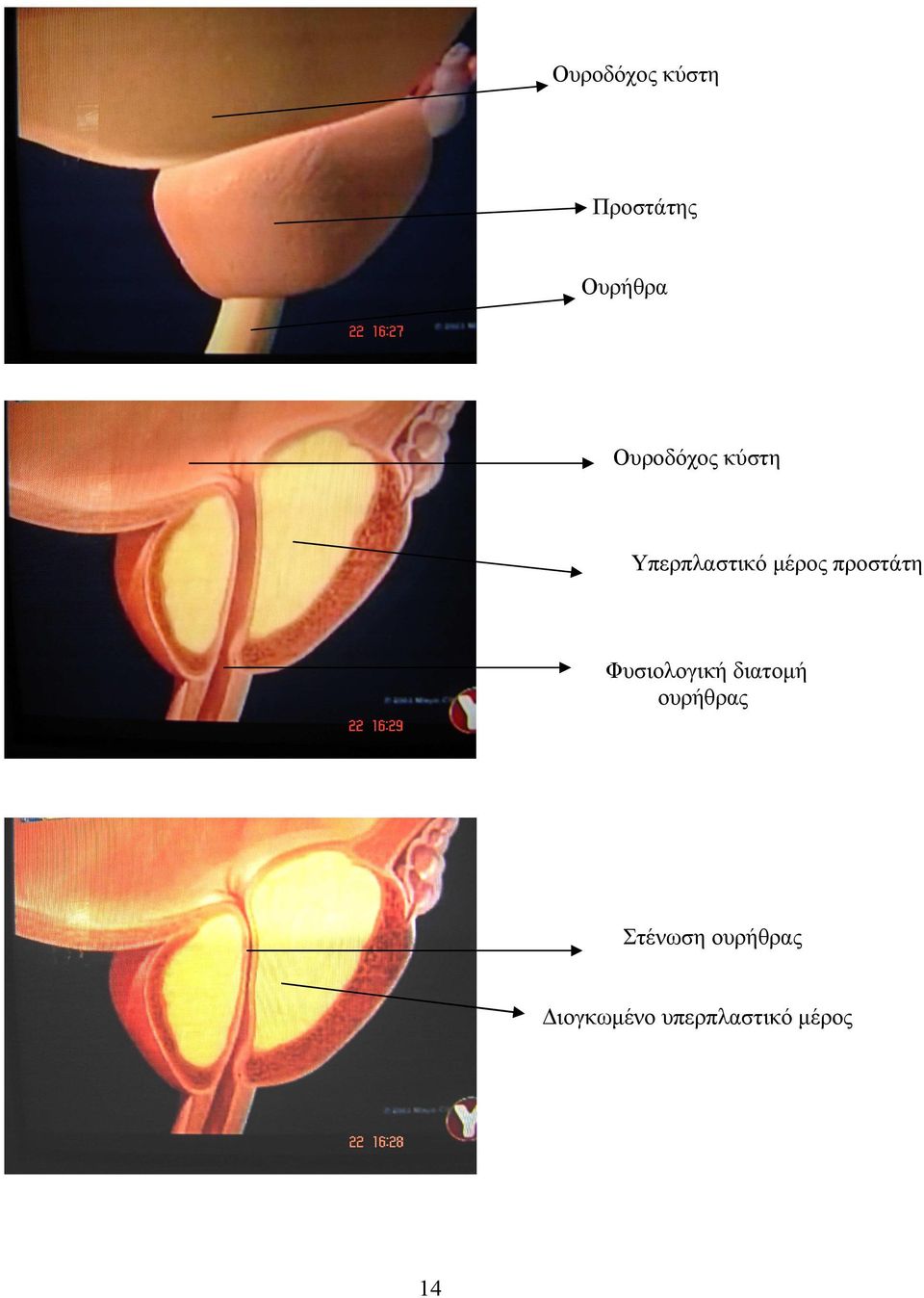 προστάτη Φυσιολογική διατοµή ουρήθρας