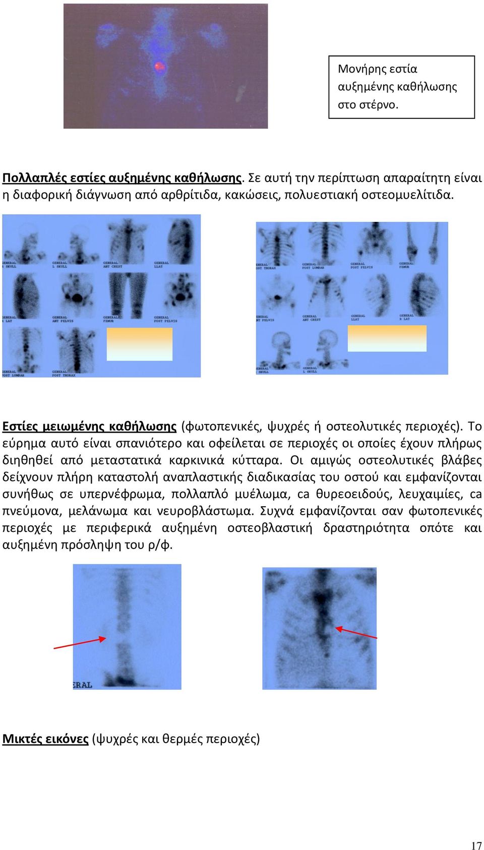 Οι αμιγώς οστεολυτικές βλάβες δείχνουν πλήρη καταστολή αναπλαστικής διαδικασίας του οστού και εμφανίζονται συνήθως σε υπερνέφρωμα, πoλλαπλό μυέλωμα, ca θυρεοειδούς, λευχαιμίες, ca πνεύμονα,