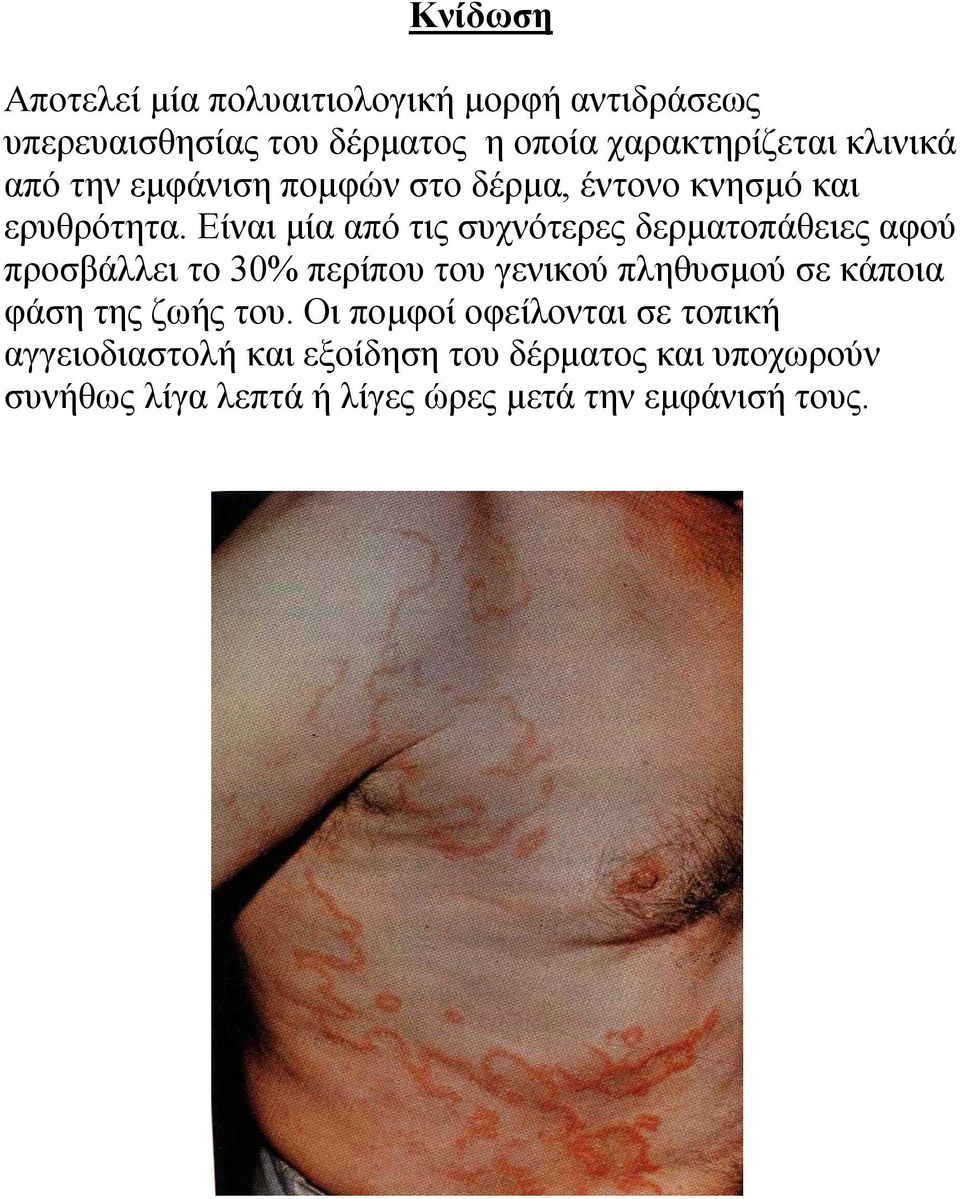 Δίλαη κία από ηηο ζπρλόηεξεο δεξκαηνπάζεηεο αθνύ πξνζβάιιεη ην 30% πεξίπνπ ηνπ γεληθνύ πιεζπζκνύ ζε θάπνηα θάζε
