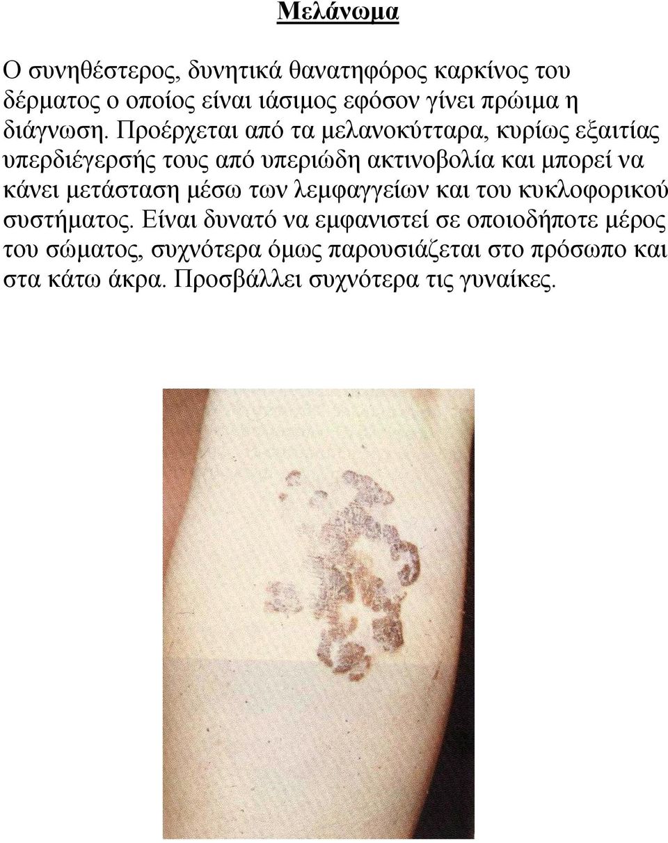 Πξνέξρεηαη από ηα κειαλνθύηηαξα, θπξίσο εμαηηίαο ππεξδηέγεξζήο ηνπο από ππεξηώδε αθηηλνβνιία θαη κπνξεί λα θάλεη