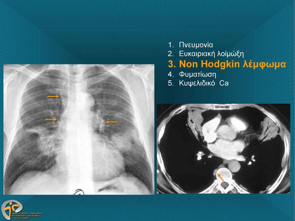 Non Hodgkin λέμφωμα 4.