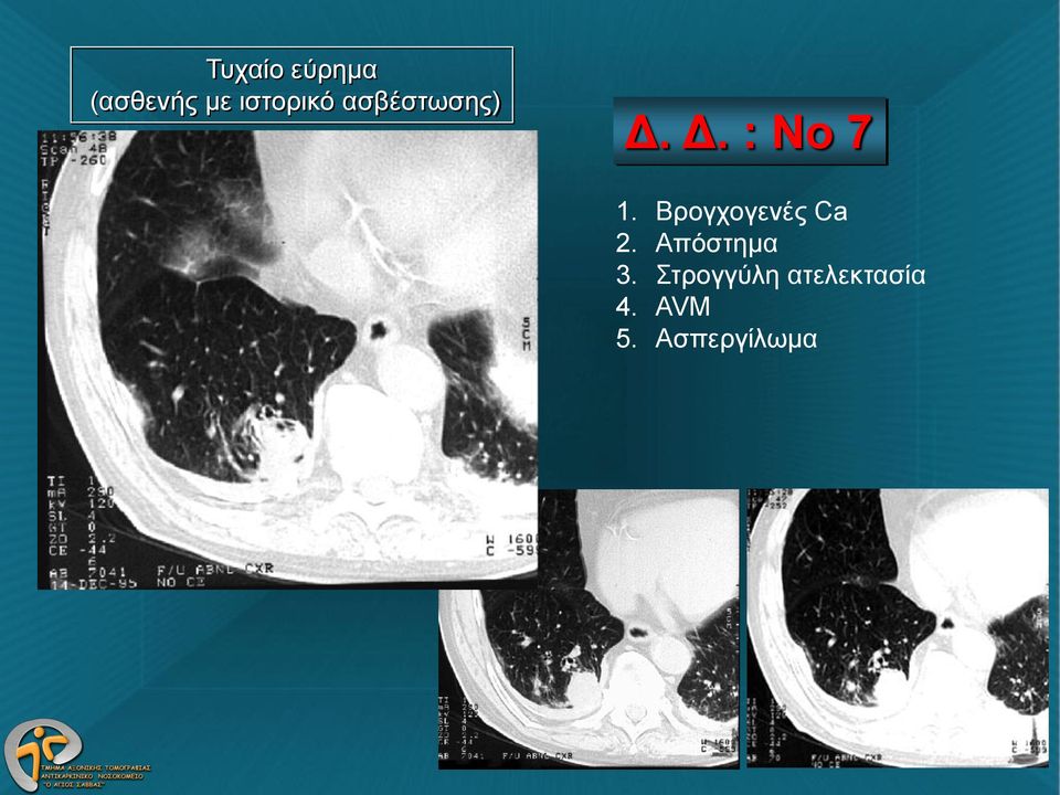 Βρογχογενές Ca 2. Απόστημα 3.
