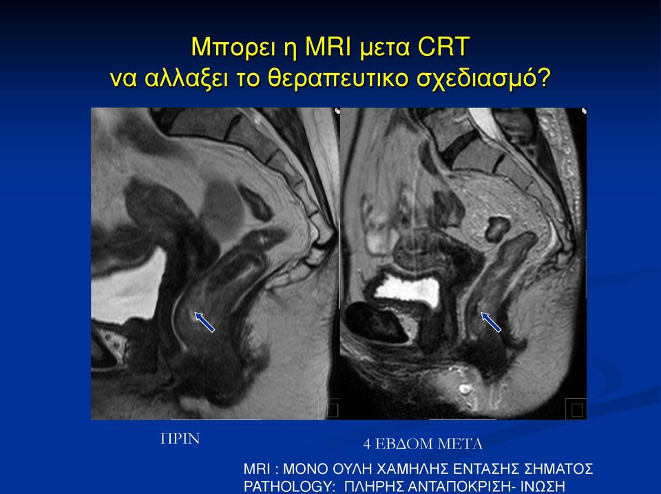 ΠΡΙΝ 4 ΕΒΔΟΜ ΜΕΤΑ MRI : ΜΟΝΟ ΟΥΛΗ