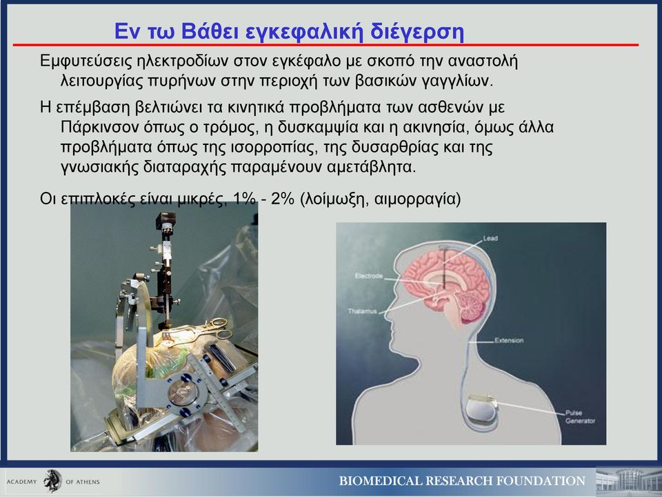 Η επέμβαση βελτιώνει τα κινητικά προβλήματα των ασθενών με Πάρκινσον όπως ο τρόμος, η δυσκαμψία και η