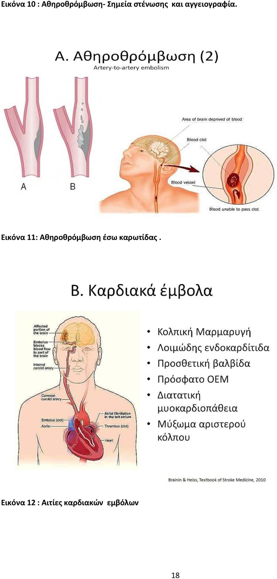 Εικόνα 11: Αθηροθρόμβωση έσω