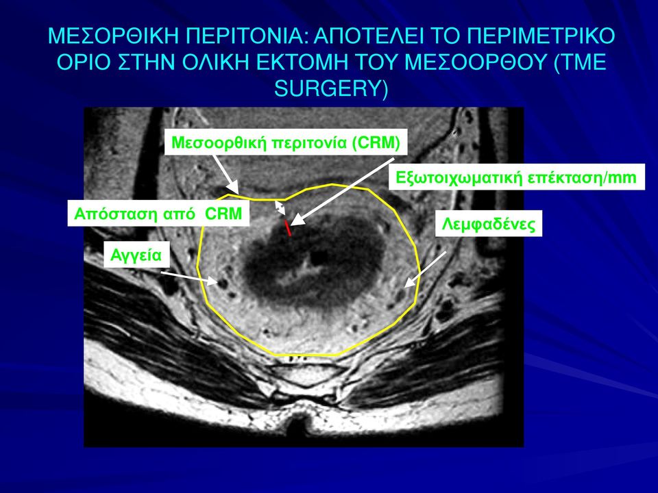 SURGERY) Μεσοορθική περιτονία (CRM)