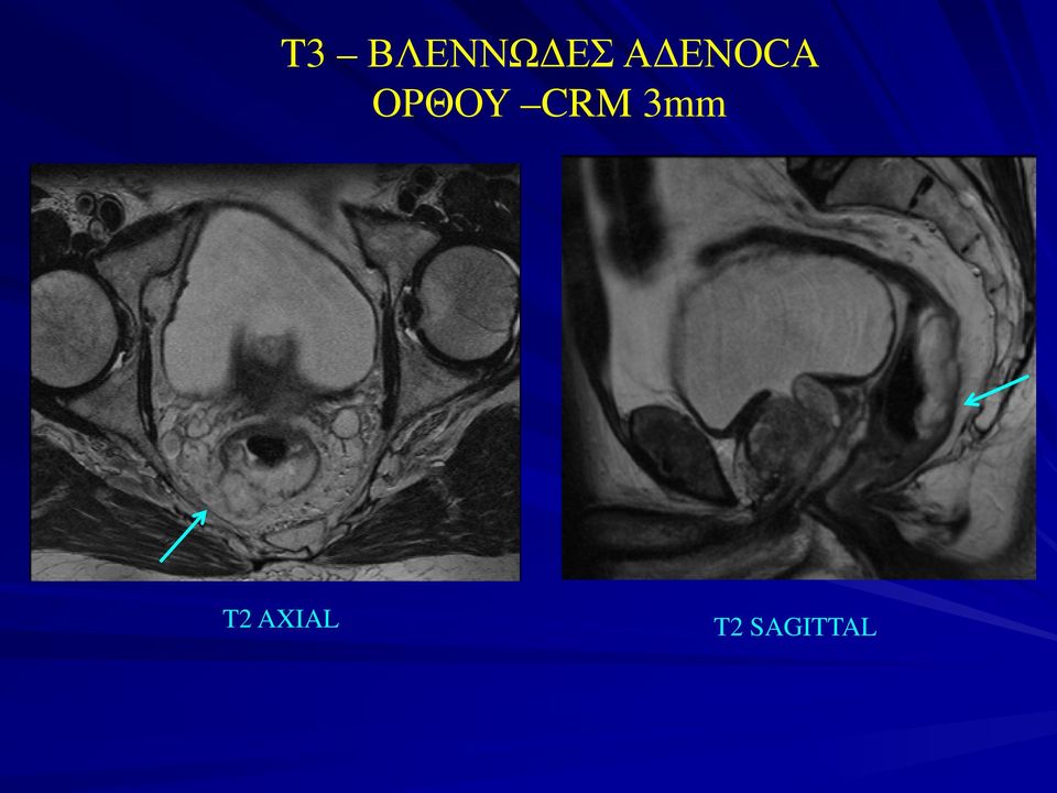 CRM 3mm T2