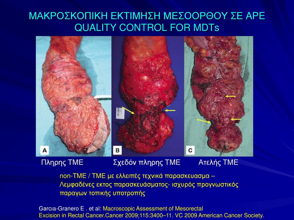 ισχυρός προγνωστικός παραγων τοπικής υποτροπής Garcıa-Granero E.