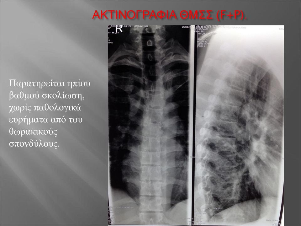 ευρήματα από του θωρακικούς