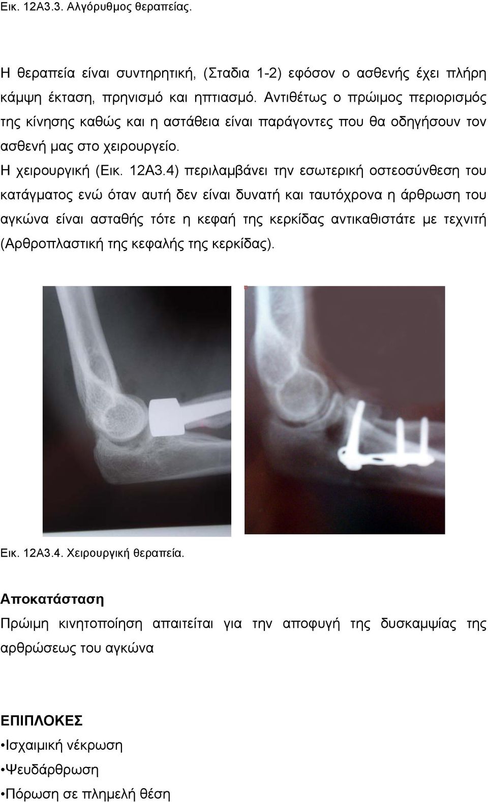 4) περιλαµβάνει την εσωτερική οστεοσύνθεση του κατάγµατος ενώ όταν αυτή δεν είναι δυνατή και ταυτόχρονα η άρθρωση του αγκώνα είναι ασταθής τότε η κεφαή της κερκίδας αντικαθιστάτε µε