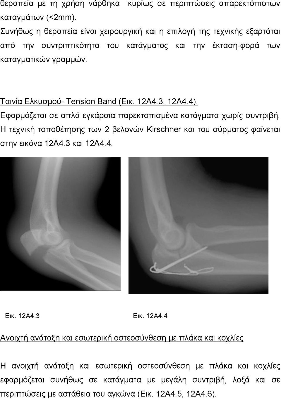 Ταινία Ελκυσµού- Tension Band (Εικ. 12Α4.3, 12Α4.4). Εφαρµόζεται σε απλά εγκάρσια παρεκτοπισµένα κατάγµατα χωρίς συντριβή.