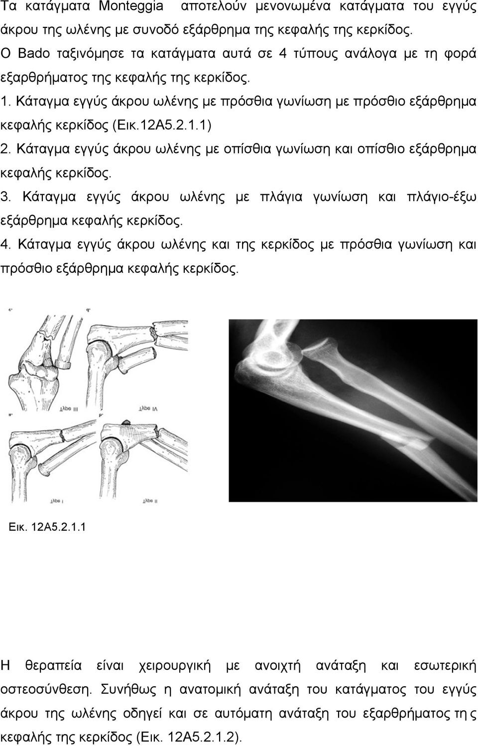 12Α5.2.1.1) 2. Κάταγµα εγγύς άκρου ωλένης µε οπίσθια γωνίωση και οπίσθιο εξάρθρηµα κεφαλής κερκίδος. 3. Κάταγµα εγγύς άκρου ωλένης µε πλάγια γωνίωση και πλάγιο-έξω εξάρθρηµα κεφαλής κερκίδος. 4.