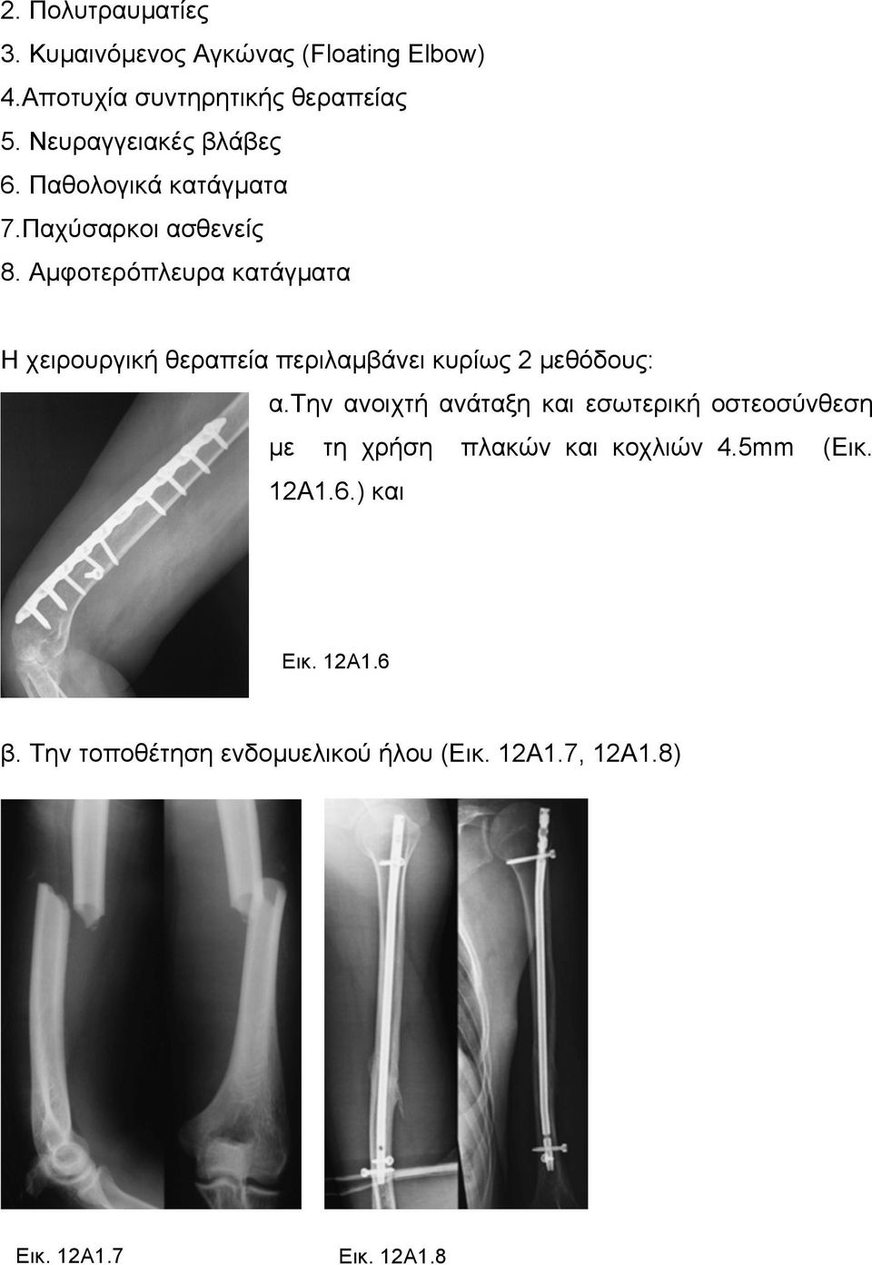 Αµφοτερόπλευρα κατάγµατα Η χειρουργική θεραπεία περιλαµβάνει κυρίως 2 µεθόδους: α.