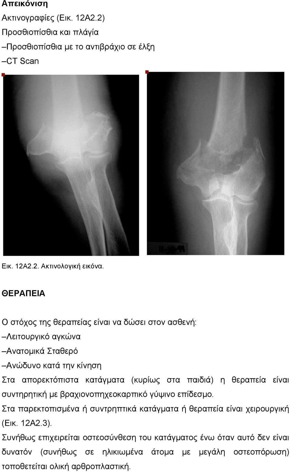 στα παιδιά) η θεραπεία είναι συντηρητική µε βραχιονοπηχεοκαρπικό γύψινο επίδεσµο. Στα παρεκτοπισµένα ή συντρηπτικά κατάγµατα ή θεραπεία είναι χειρουργική (Εικ.