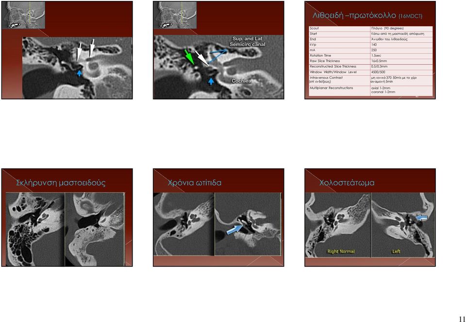 3mm Window Width/Window Level 4500/500 Intravenous Contrast (επί ενδείξεως) Multiplanar Reconstructions μη ιονικό 370 50mls με το χέρι αναμονή 5min axial 1-2mm