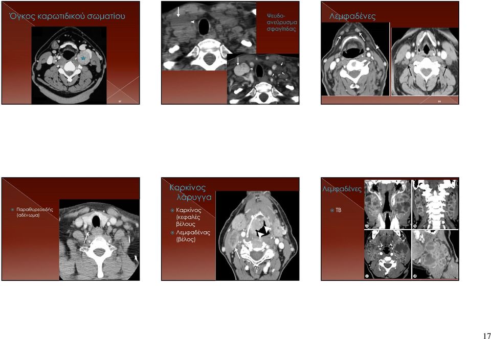 The patient, who had undergone multiple renal transplantations and placement of central catheters, presented with a