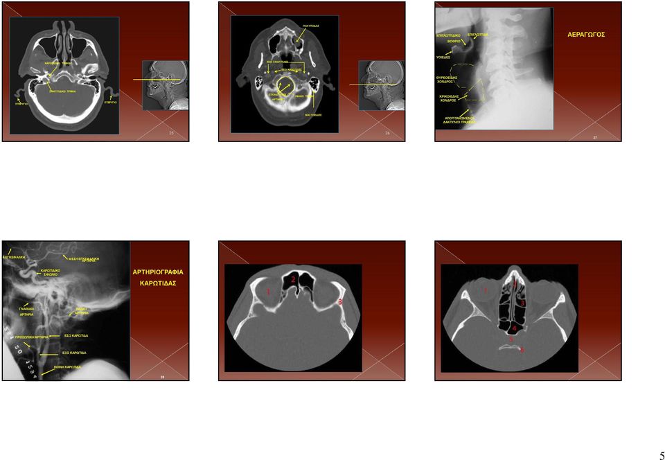 ΕΓΚΕΦΑΛΙΚΗ ΑΡΤΗΡΙΑ ΚΑΡΩΤΙΔΙΚΟ ΣΙΦΩΝΙΟ ΑΡΤΗΡΙΟΓΡΑΦΙΑ ΓΝΑΘΙΑΙΑ ΑΡΤΗΡΙΑ ΙΝΙΑΚΗ ΑΡΤΗΡΙΑ ΚΑΡΩΤΙΔΑΣ 1, Orbital cavity. 2, Frontal sinus. 3, Sphenoid bone.