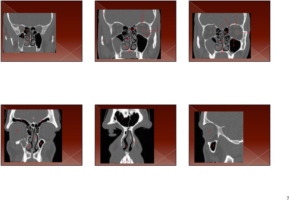 2, Superior oblique muscle. 3, Superior rectus muscle. 4, Lateral rectus muscle. 5, Inferior rectus muscle. 6, Medial rectus muscle. 7, Optic nerve. 8, Middle turbinate. 9, Inferior turbinate.